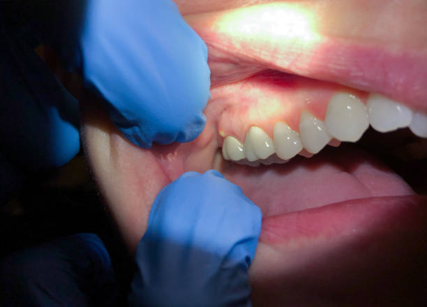 Best Lost Filling or Crown Replacement in Oakwood, PA